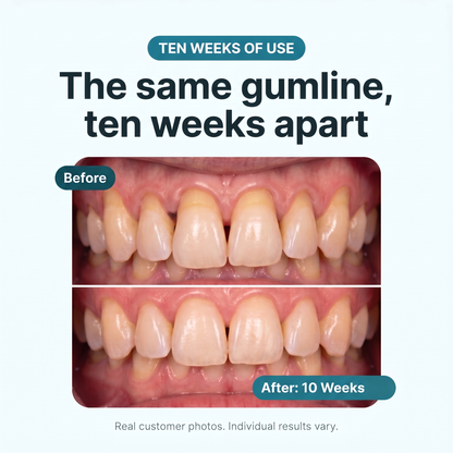 Restore Receding & Damaged Gums - CollaGum™
